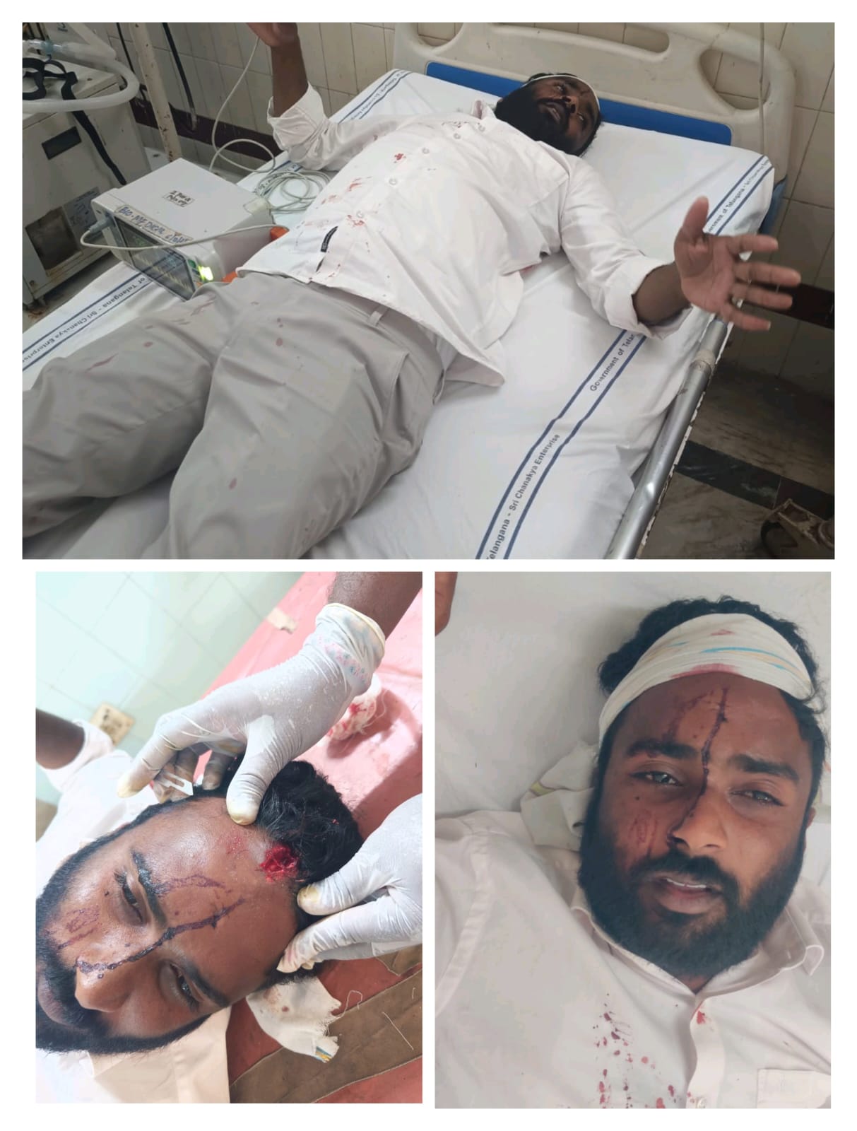 బిఆర్ఎస్ రాళ్ళ దాడిలో కాంగ్రెస్ నాయకుడు జావిధ్ ఖాన్ కు తీవ్ర గాయాలు